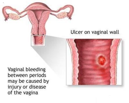 Inter Menstrual Bleeding