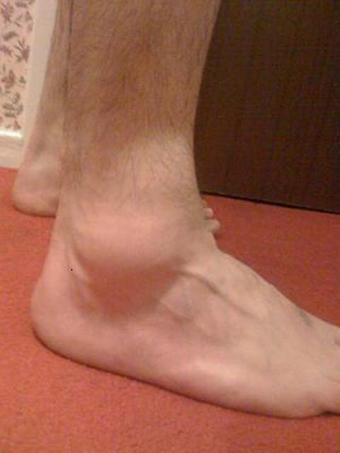 Swollen Ankles2