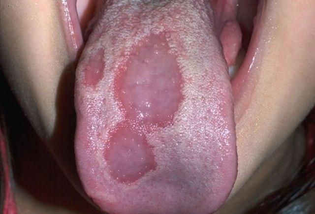 Secondary Syphilis: Causes, Symptoms & Diagnosis