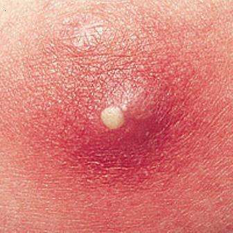 what causes boils on the body