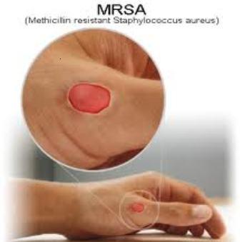 mercer disease pictures | Lifescript.com