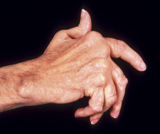 Arthritis1
