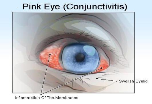 Pink eye1