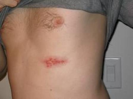 Shingles2