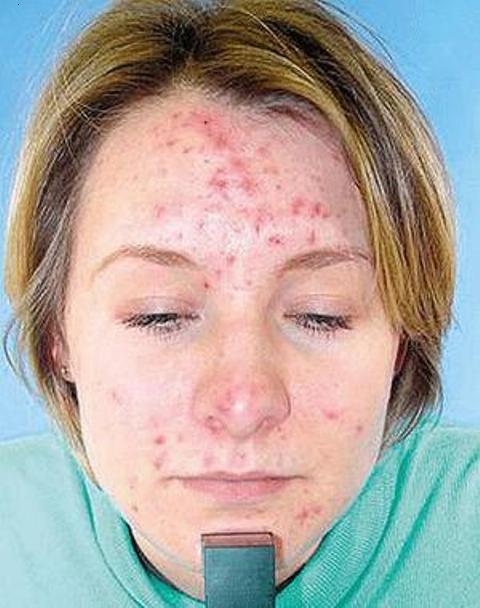 acne2