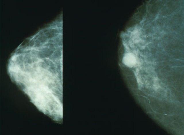 breast cancer1