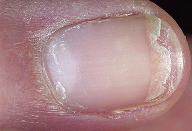 fingernail problems2. Fungus in nails changes the colour and texture of the