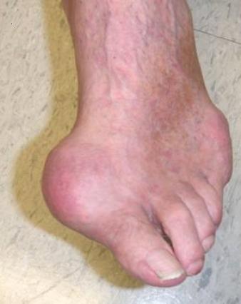 gout1
