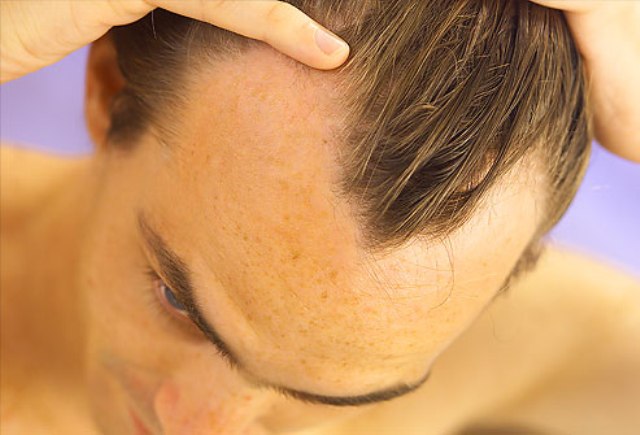 hair loss1