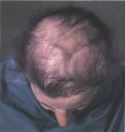hair loss3