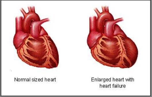 heart failure2