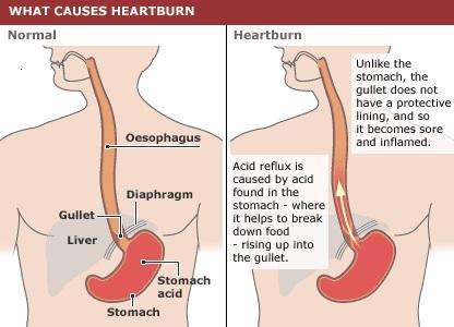 heartburn1