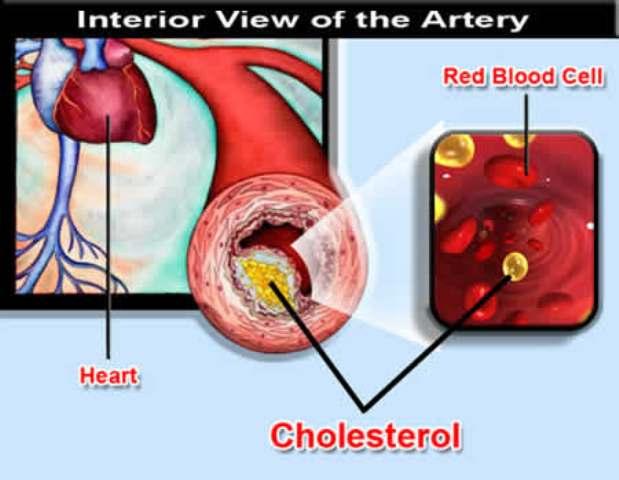 What causes high cholesterol? – What causes this?