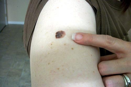 What causes moles?