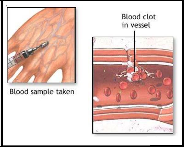 blood clots1