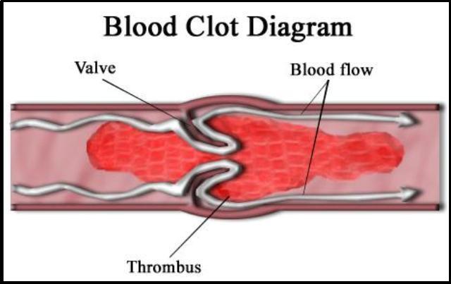 blood clots2