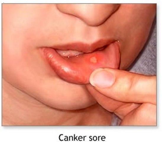 canker sores2