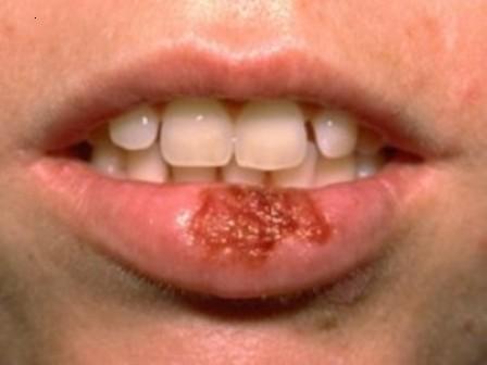 cold sores2