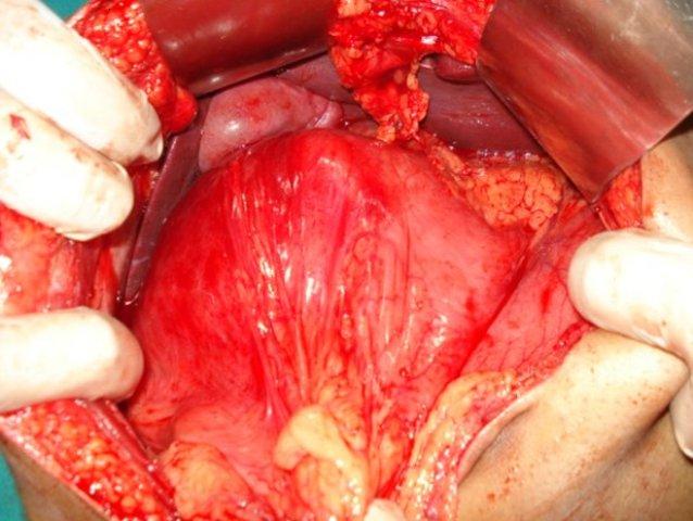 pancreatitis1