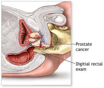 prostate cancer2