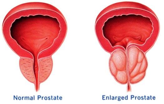 prostate cancer2