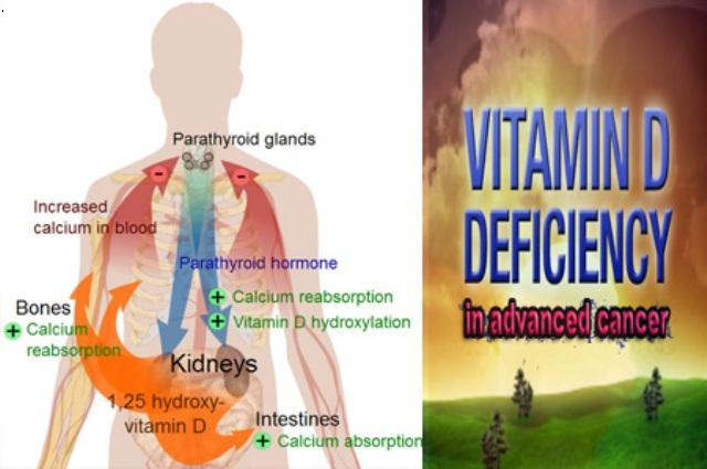 vitamin D deficiency1